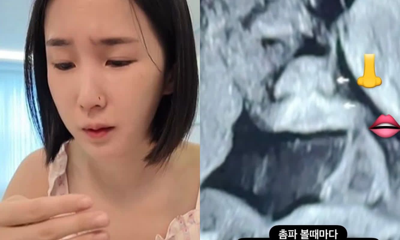 초아, 자궁경부암 수술 고충 고백