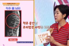 정은아, 척추 괴사 환자 사진에 충격…”척추압박골절 방치 탓” (‘몸신의 탄생’) [종합]